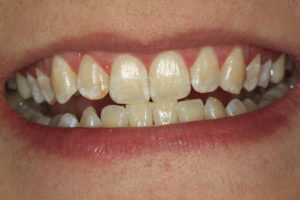 Wybielanie zębów światłem efekt przed